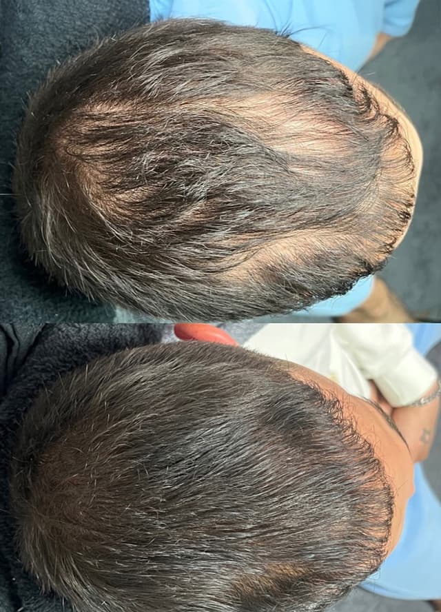 Scalp Micropigmentation for Men