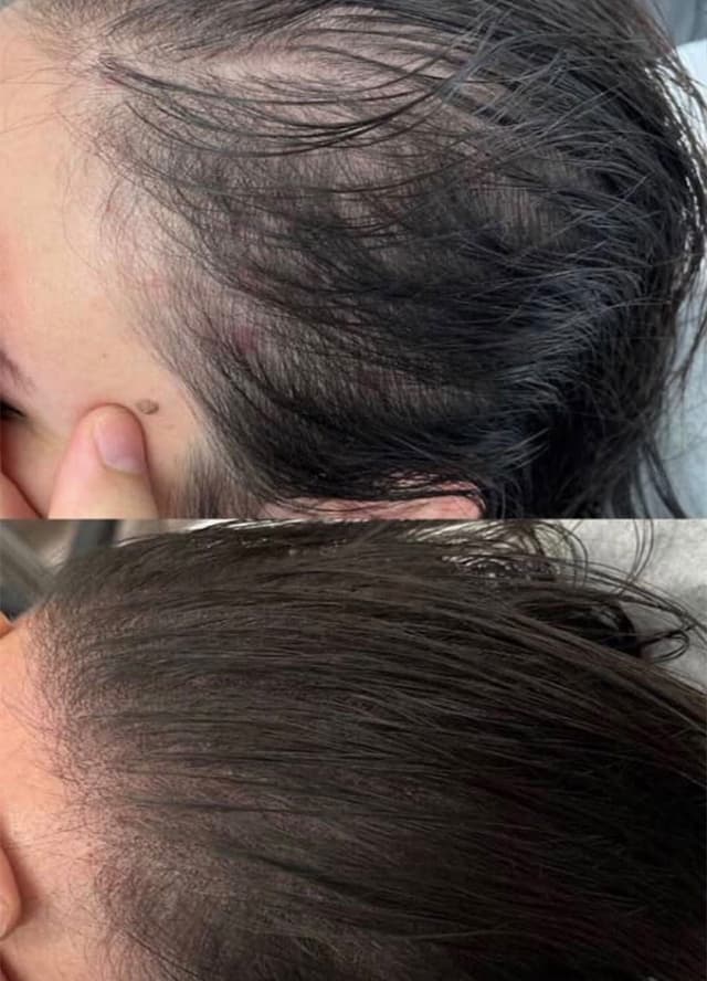 Scalp Micropigmentation for Women